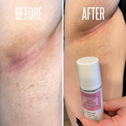 Save 14% on The Skin Care Solution For Dark Spots, Razor Bumps, Ingrown Hair & Razor Burns – Includes Our Ultra Potent Bri...