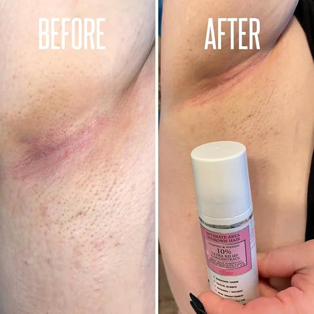 Save 14% on The Skin Care Solution For Dark Spots, Razor Bumps, Ingrown Hair & Razor Burns – Includes Our Ultra Potent Bri...