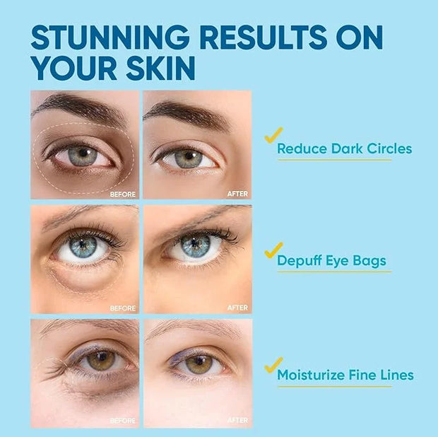 Under Eye Patches for Women: 30 Pairs of Hydrating Collagen Gel Eye Masks with Retinol & Hyaluronic Acid - Smooths Fine Li...