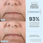 NuFACE FIX Line Smoothing Starter Kit - FDA Cleared Microcurrent Device + Serum Activator for On-The-Go Treatment of Foreh...