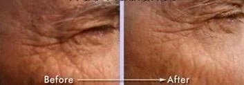 Best Lineless Eye Cream Reduces Crows Feet, Dark Circles and Puffinesss. Anti-wrinkle and More. 10% Reguage, 10% Syncoll, ...