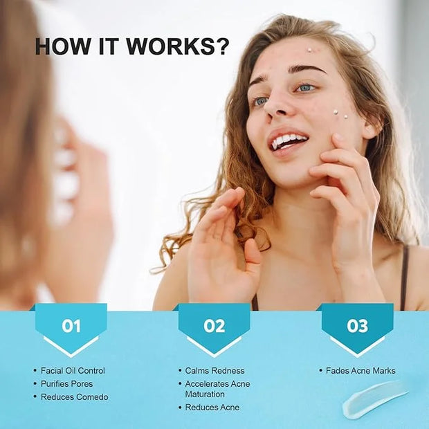Acne Pimple Spot Treatment Cream: Cystic Hormonal Blackheads Blemish Remover for Face, Back and Body - with 10% Azelaic Ac...