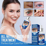 Stye Eye Treatment, Natural Stye Remover, Eye Stye Relief Serum, Premium Formula - Gentle Cleanser for Chalazion & Blephar...