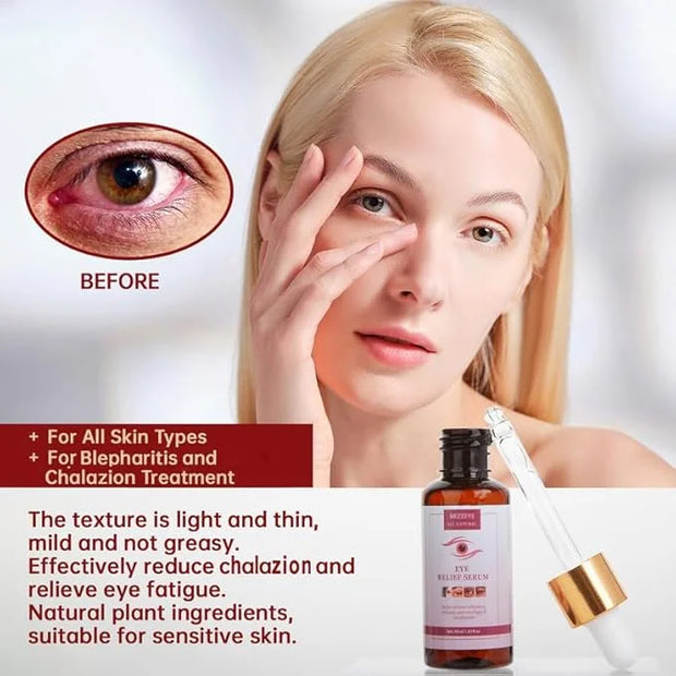 Chalazion Eye Treatment For Blepharitis, 2 PCS Moisturize Eyelids Serum and Chalazion Remover, Gentle Under Eye Relief Ser...