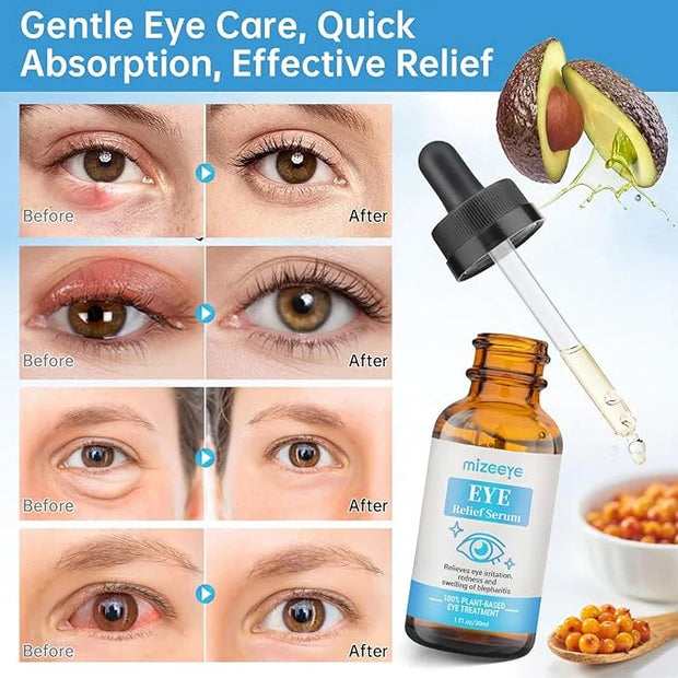 Eye Serum For Chalazion & Blepharitis Treatment, 2 PCS Chalazion Remover For Eyelid Treatment, Eyelid Serum With Avocado O...