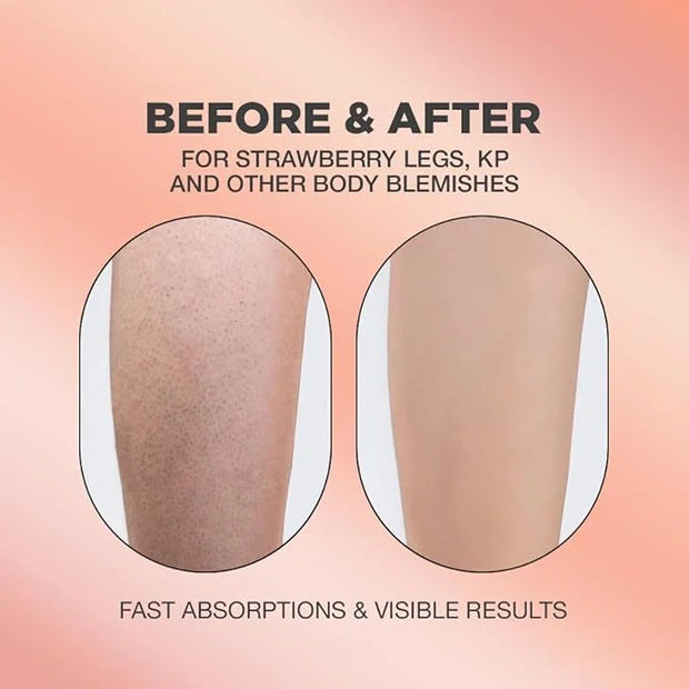Strawberry Legs Exfoliating Serum + KP Body Cream Bundle | Keratosis Pilaris and Strawberry Legs Skincare Formula for Smoo...