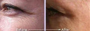 Best Lineless Eye Cream Reduces Crows Feet, Dark Circles and Puffinesss. Anti-wrinkle and More. 10% Reguage, 10% Syncoll, ...