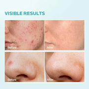 ZealSea 10% Azelaic Acid Facial Cream - Azelaic Acid Serum with AHA for Face, Relief Pimple, Breakouts, Blackhead & Rednes...