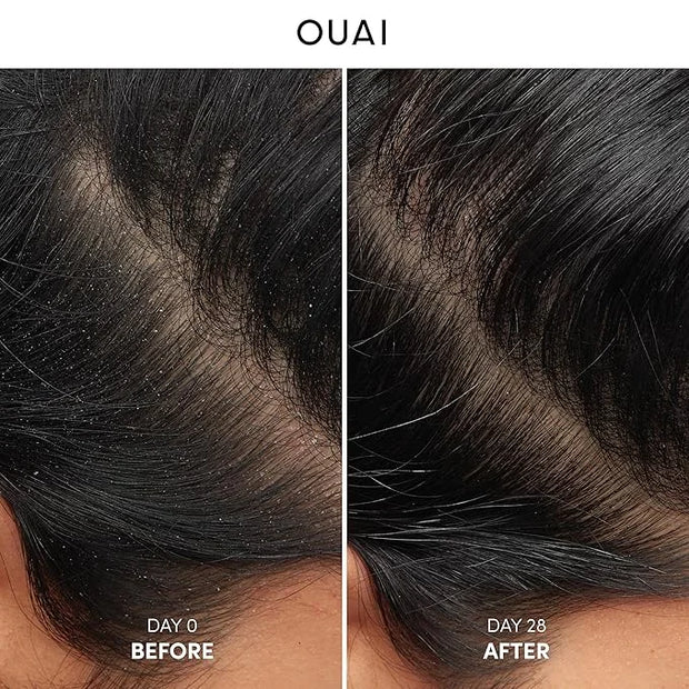 OUAI Detox Shampoo (10 fl oz) & Anti-Dandruff Deluxe Size (1 fl oz) Bundle - Soothing, Clarifying Shampoo Set for Dry, Fla...