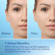 Differin acne treatment gel, 90