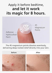 EasyDerm Quick Calming Magnesium Patches – Hydrocolloid Acne Spot Treatment Includes Tweezers & Ampoule, 10 Patches, Zit S...