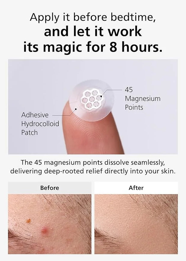 EasyDerm Quick Calming Magnesium Patches – Hydrocolloid Acne Spot Treatment Includes Tweezers & Ampoule, 10 Patches, Zit S...