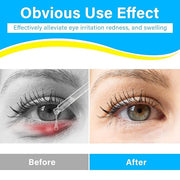 Stye Eye Treatment, Natural Stye Treatment Serum for Styes Chalazion and Blepharitis, Mild & Fast Relief - Product Image
