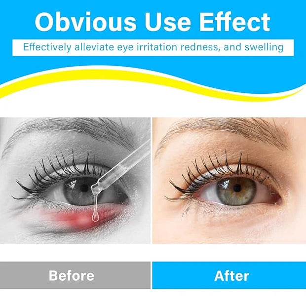 Stye Eye Treatment, Natural Stye Treatment Serum for Styes Chalazion and Blepharitis, Mild & Fast Relief - Product Image
