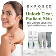 Exposed Skin Care Acne Treatment Kit - Includes Facial Cleanser, Clearing Tonic, Acne Treatment Serum, Clear Pore Serum, C...