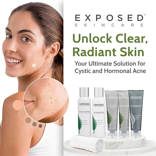 Exposed Skin Care Acne Treatment Kit - Includes Facial Cleanser, Clearing Tonic, Acne Treatment Serum, Clear Pore Serum, C...