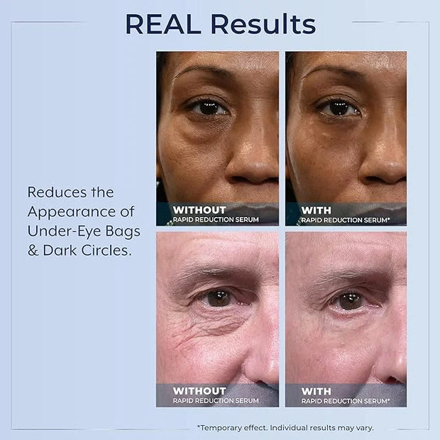 Plexaderm Rapid Reduction Eye Serum - Visibly Reduces Under-Eye Bags, Wrinkles, Dark Circles, Fine Lines & Crow's Feet Ins...