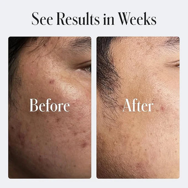 Geologie Skin Repair Moisturizer Face Cream | Clear System Retinol Resurfacing Formula | For Blemish Prone Skin with Niaci...