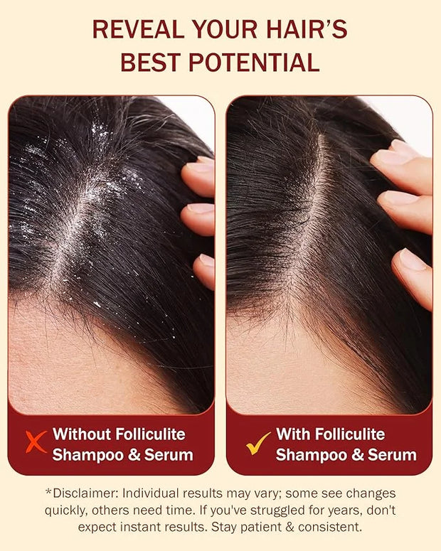 3% BHA Folliculitis Shampoo & Leave-On Hair Serum Set - Made with Salicylic Acid, Aloe Vera & Tea Tree Oil - Moisturizing ...