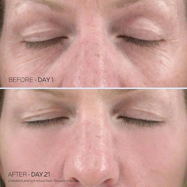 Dr. Pure Under Eye Patches for Wrinkles: Retinol Collagen Eye Mask for Puffy Eyes and Dark Circles with Hyaluronic Acid - ...