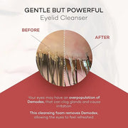 ZocuFoam Eyelid Cleanser - Foaming Eyelid Scrub - Natural pH Balanced Solution - 25mL - Product Image