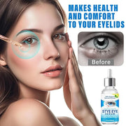 Stye Eye Treatment, Natural Stye Eye Relief Serum, for Styes Chalazion and Blepharitis Treatment, Restored Healthier Eye S...