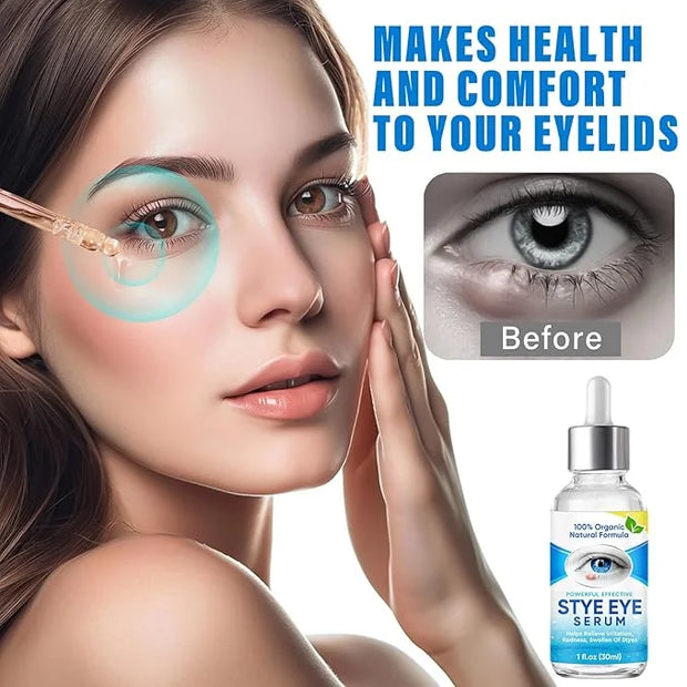 Stye Eye Treatment, Natural Stye Eye Relief Serum, for Styes Chalazion and Blepharitis Treatment, Restored Healthier Eye S...